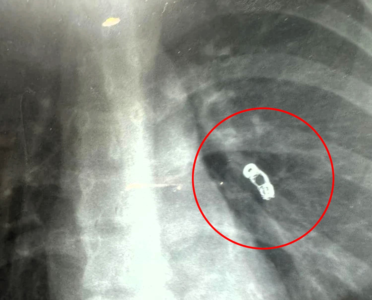 Influencer with cold symptoms stunned as doctors find metal coil in her lungs from past surgery 1 Russian influencer Ekaterina Badulina's common cold symptoms led to a shocking discovery—a metal spring in her lung from past surgery. Read her incredible survival story!