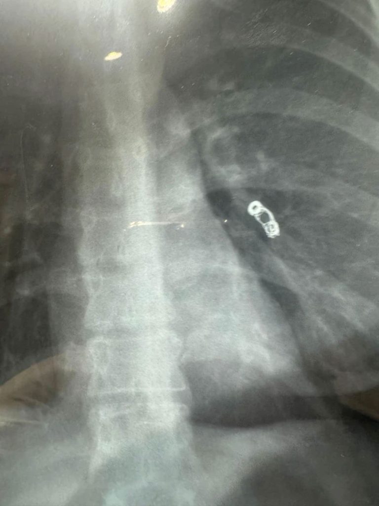 Influencer with cold symptoms stunned as doctors find metal coil in her lungs from past surgery 3 Russian influencer Ekaterina Badulina's common cold symptoms led to a shocking discovery—a metal spring in her lung from past surgery. Read her incredible survival story!